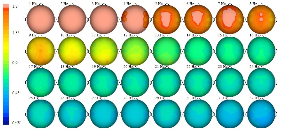 qEEG brain map in ADHD – frontal theta dominance, Siever (2016)